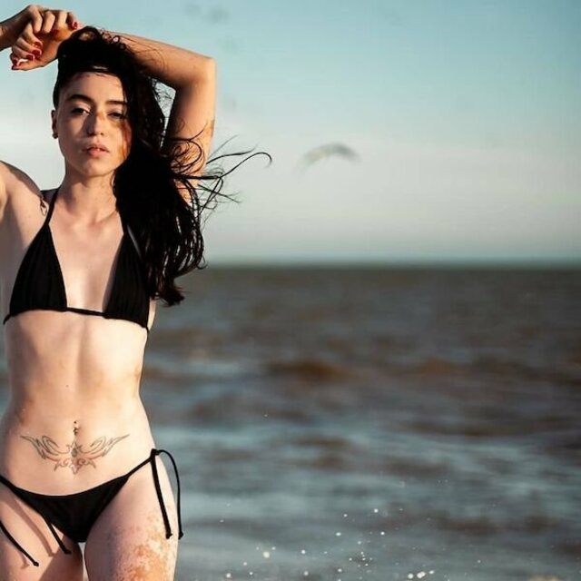 Girl With Vitiligo Show Her Beauty Through Modeling free nude pictures