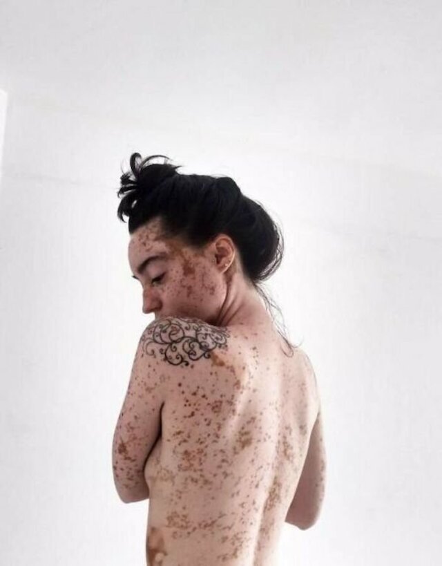 Girl With Vitiligo Show Her Beauty Through Modeling free nude pictures